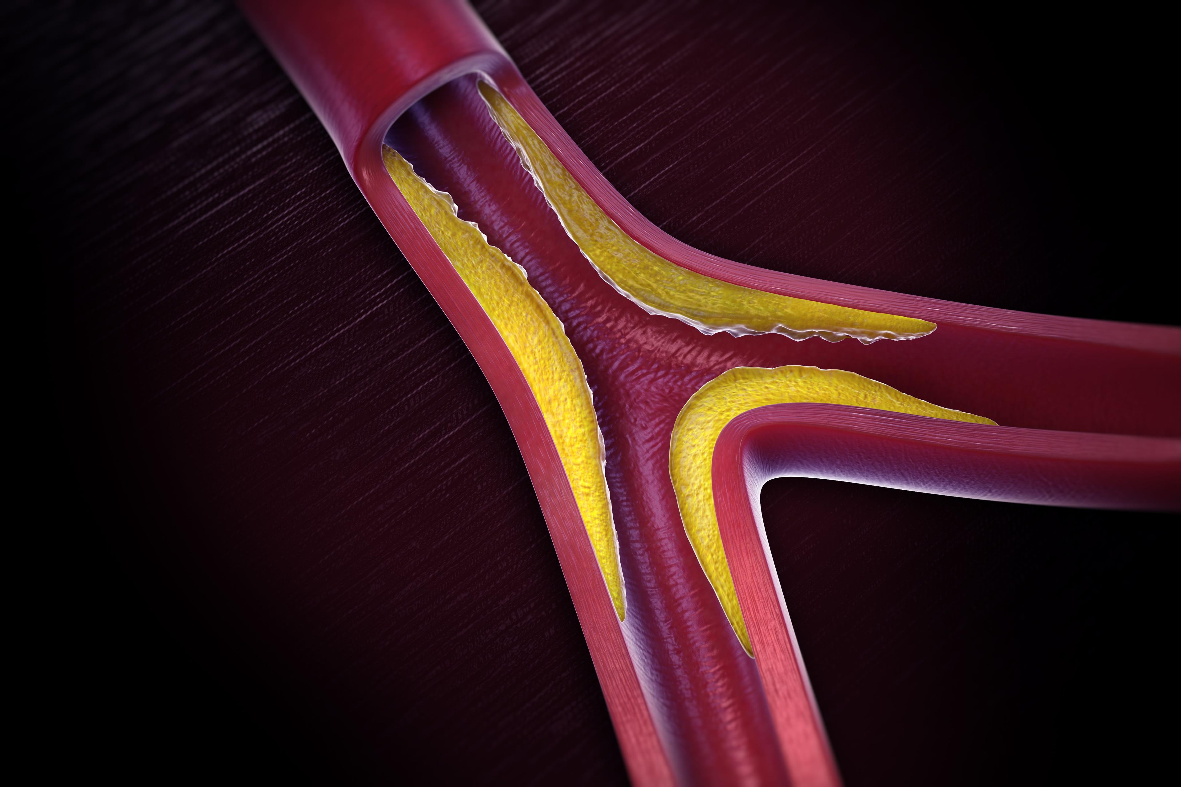Article on What you have to know about Peripheral Artery Disease?