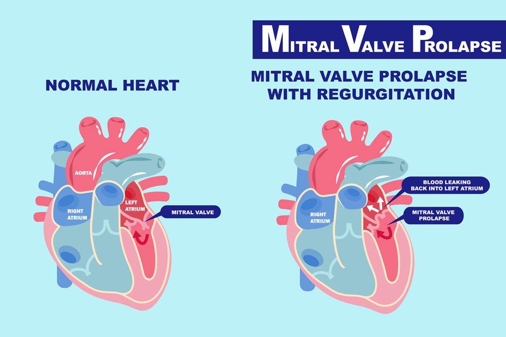 Article on How to deal with Mitral Valve Prolapse?
