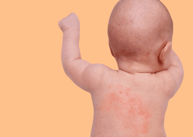 What is Eczema?