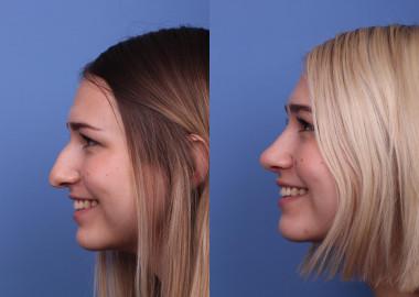 What is nose job surgery (Rhinoplasty)?