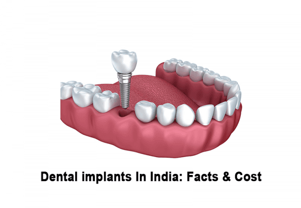 Article on Low-cost dental implants are available in India