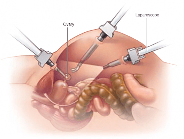 Article on Hysterectomy Surgery