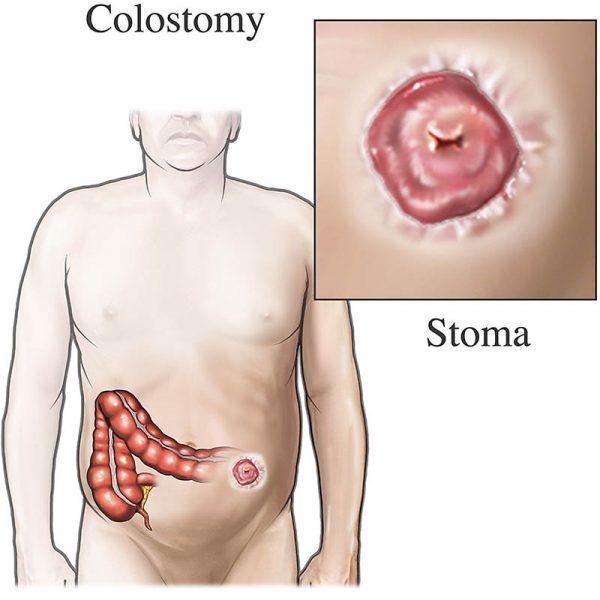 Article on Colostomy Treatment in India