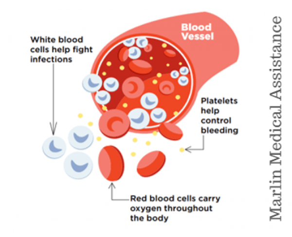 Article on Bone Marrow Transplant (Stem cell transplant): Leukemia