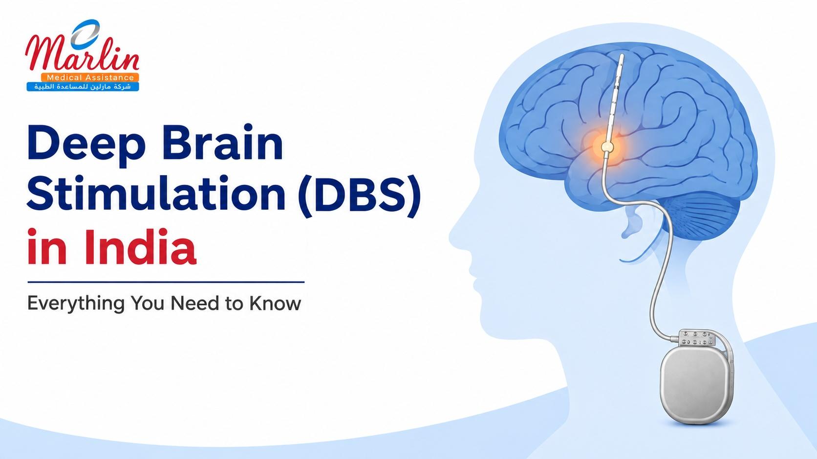 Article on Deep Brain Stimulation (DBS) in India Everything You Need to Know