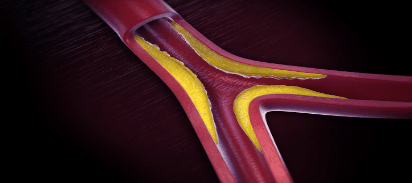 What you have to know about Peripheral Artery Disease?