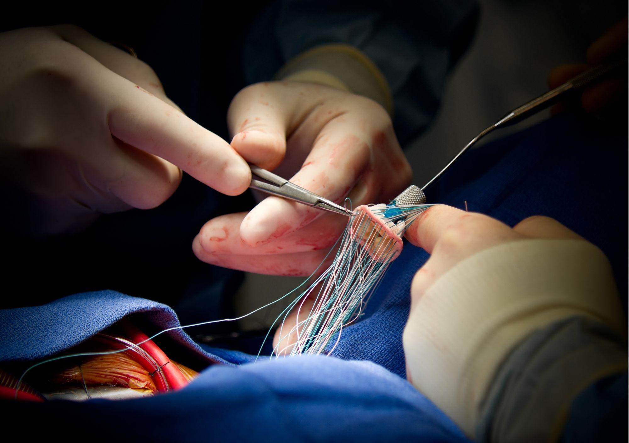 Article on Heart Valve Surgery: What you need to know