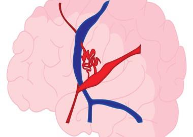 What is Arteriovenous Malformation