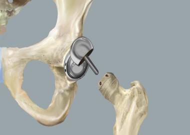 What is Birmingham Hip Resurfacing?