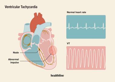 What is Ventricular Tachycardia