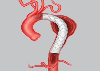 What is aortic stent grafting?