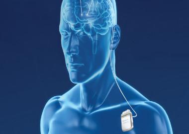 What is deep brain stimulation?