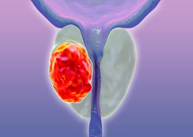 What is prostate cancer?