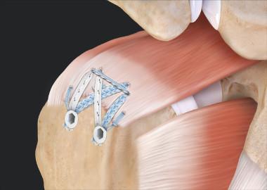 What is rotator cuff repair surgery?