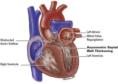 What is septal myectomy?