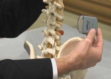 What is spinal cord stimulator?