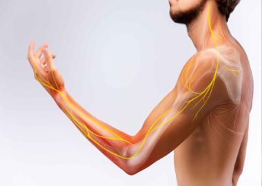 What is thoracic outlet syndrome?