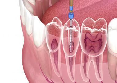 What is Root Canal