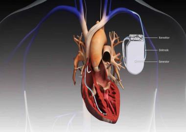 Pacemaker Implant Treatment | Marlin Medical Assistance