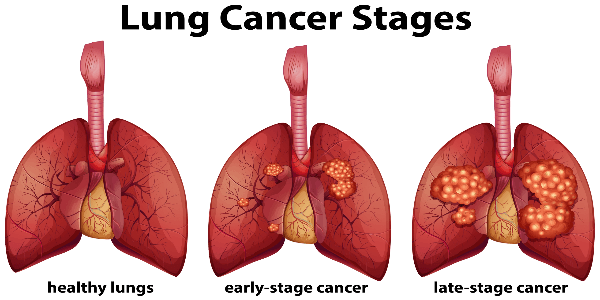 Article on Lung cancer treatment in India