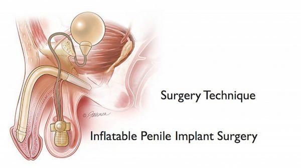 Article on Penile Implant Surgery Treatments in India