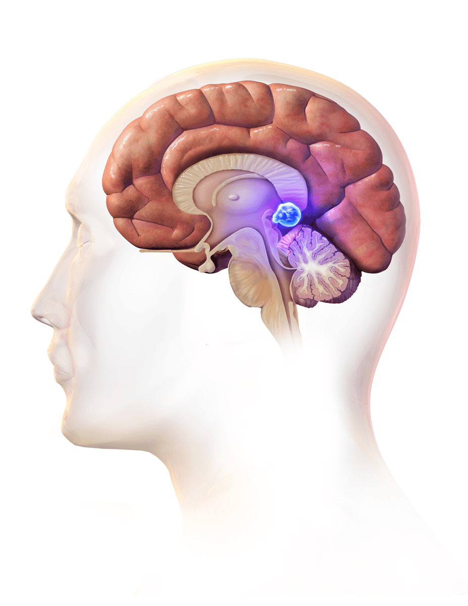 Article on Brain Tumor Symptoms, Causes, and Treatment