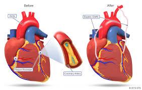 Article on CABG (Coronary Artery Bypass Grafting)