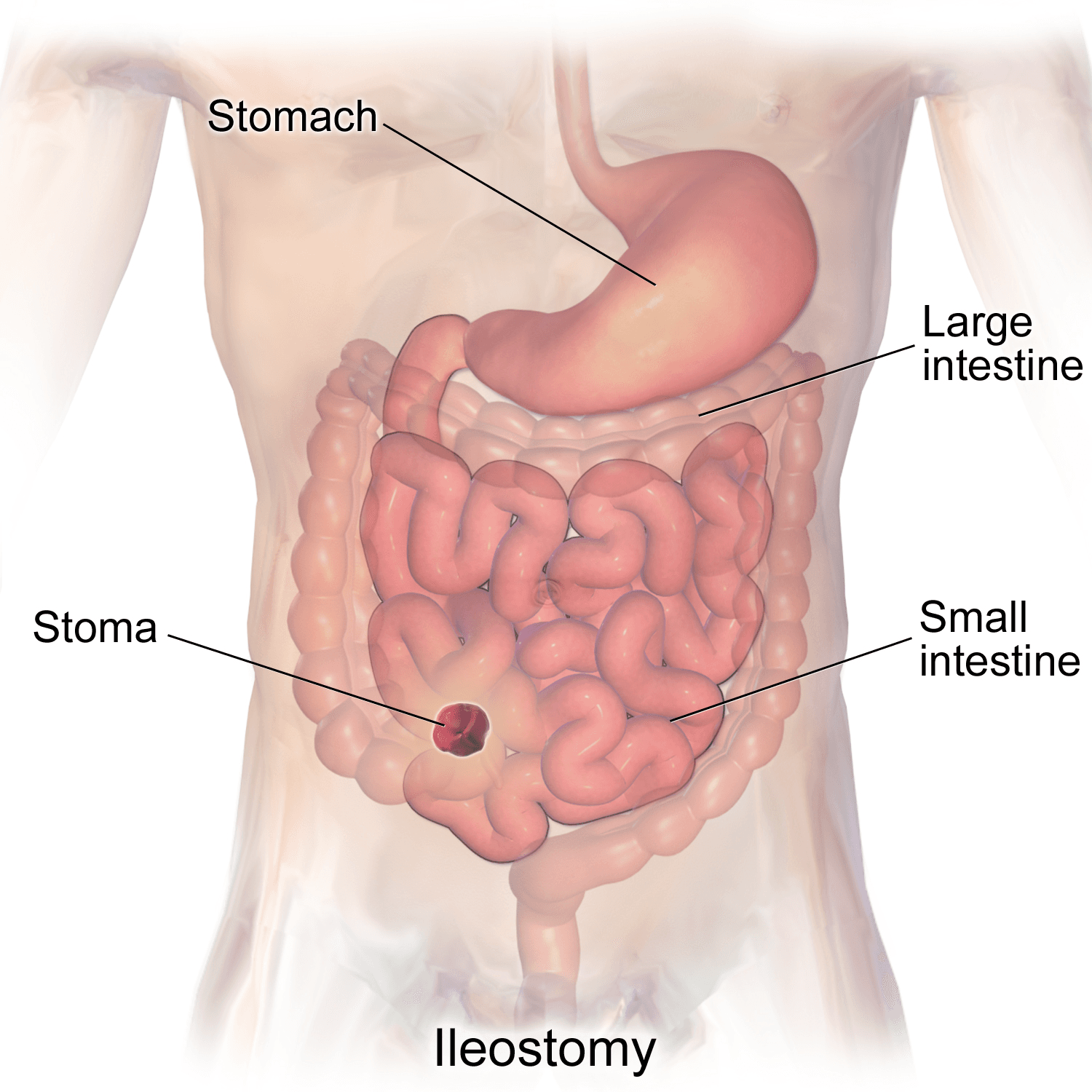 Article on Ileostomy: Procedure, Recovery, and Risks