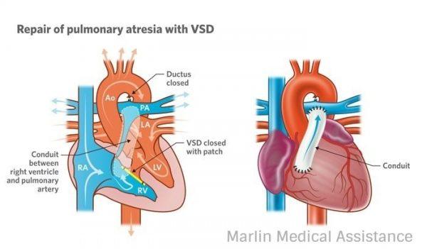 Latest News on Medical Tourism, Is medical treatment sufficient to close ASDs and VSDs?