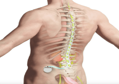 What is Spinal Cord Stimulator