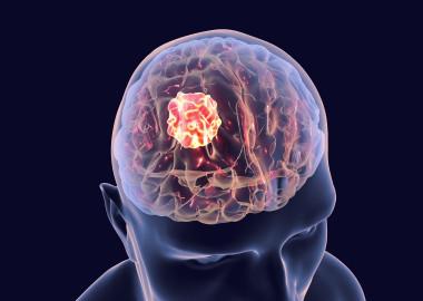 What is brain tumor?