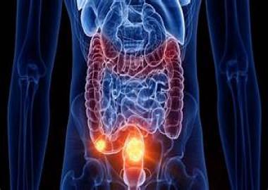 What is colon cancer?