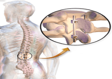 What is Disk Fusion Surgery?
