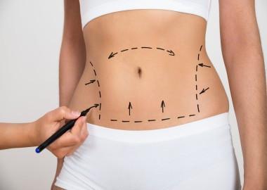 What is tummy tuck surgery?